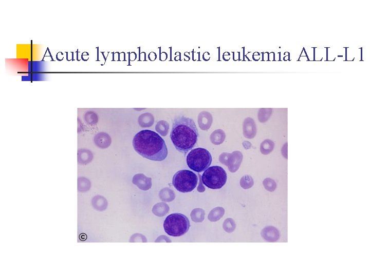 Acute lymphoblastic leukemia ALL-L 1 