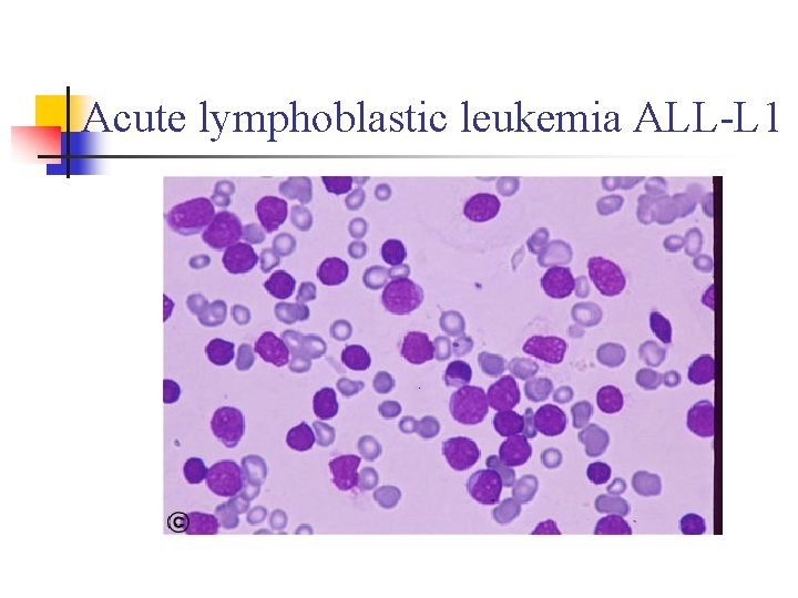 Acute lymphoblastic leukemia ALL-L 1 