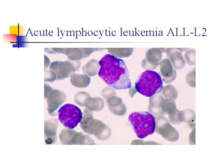 Acute lymphocytic leukemia ALL-L 2 