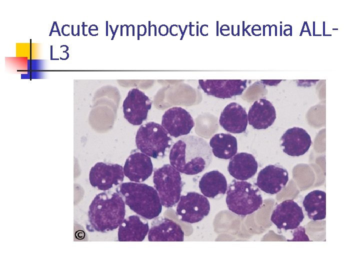 Acute lymphocytic leukemia ALLL 3 