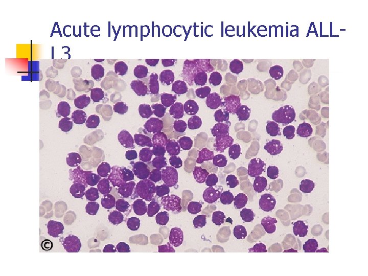 Acute lymphocytic leukemia ALLL 3 