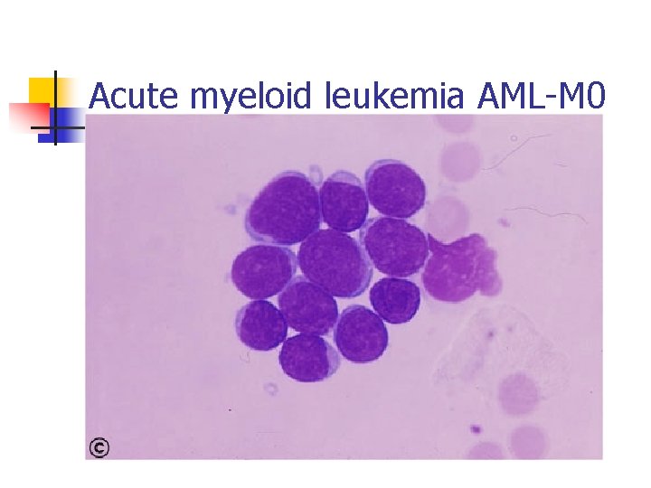 Acute myeloid leukemia AML-M 0 