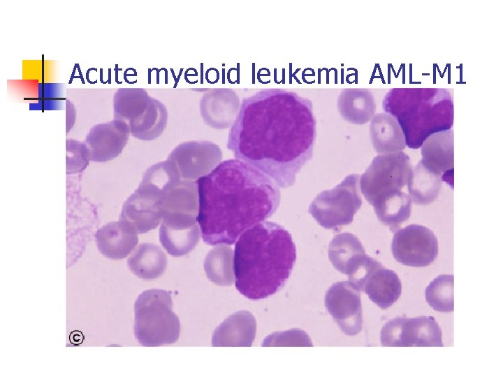 Acute myeloid leukemia AML-M 1 