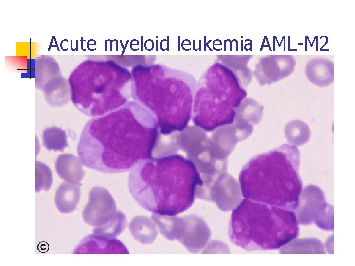 Acute myeloid leukemia AML-M 2 