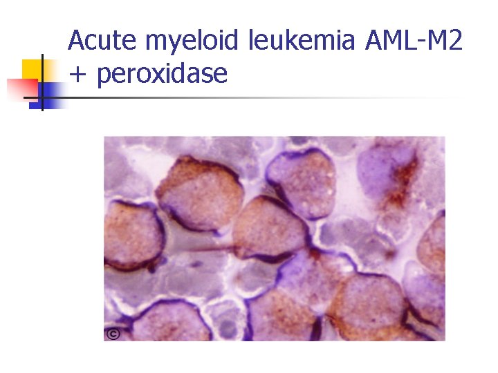 Acute myeloid leukemia AML-M 2 + peroxidase 