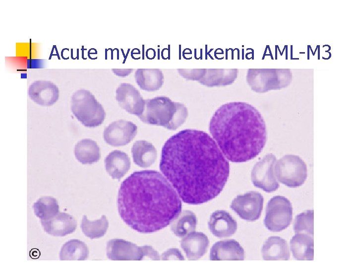 Acute myeloid leukemia AML-M 3 