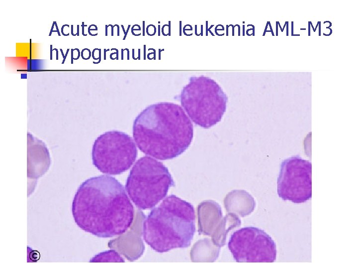 Acute myeloid leukemia AML-M 3 hypogranular 