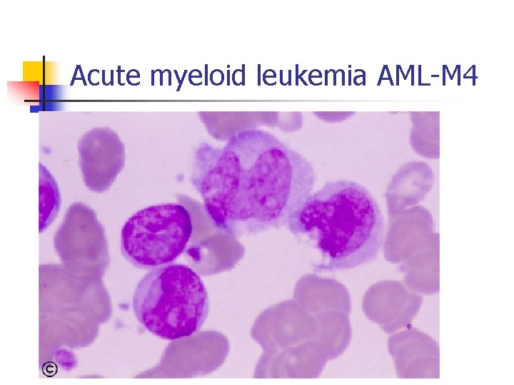 Acute myeloid leukemia AML-M 4 