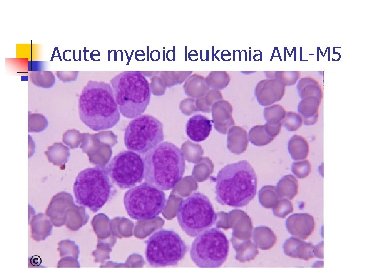 Acute myeloid leukemia AML-M 5 