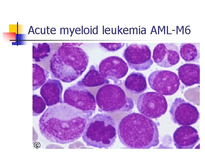 Acute myeloid leukemia AML-M 6 