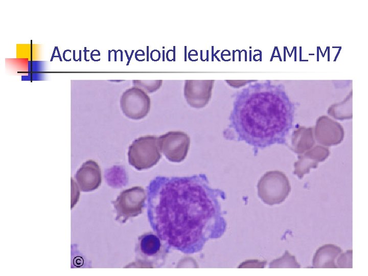 Acute myeloid leukemia AML-M 7 