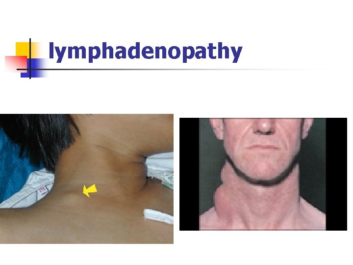 lymphadenopathy 