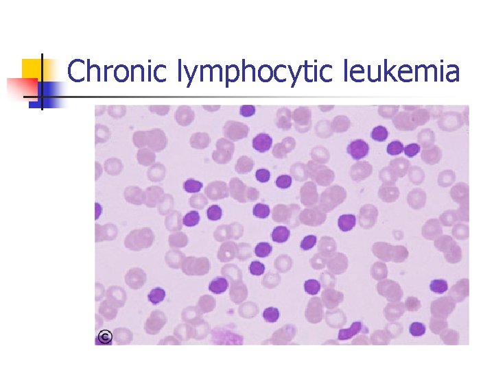 Chronic lymphocytic leukemia 