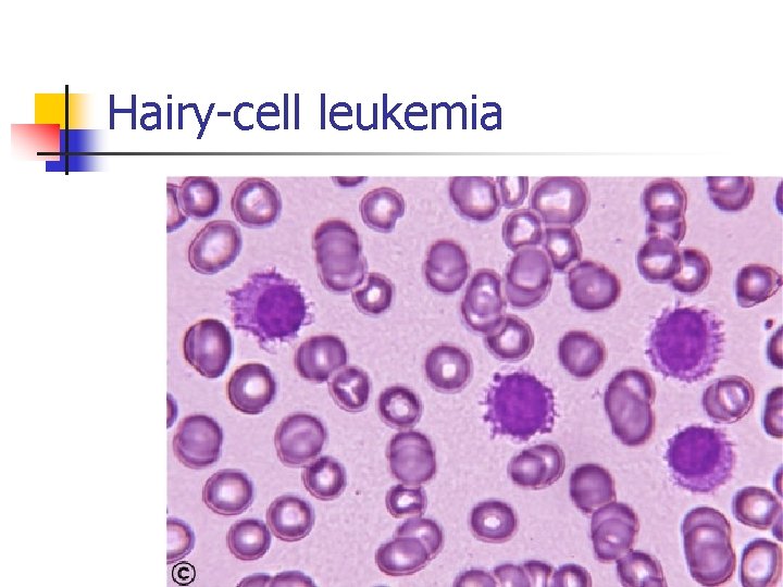 Hairy-cell leukemia 