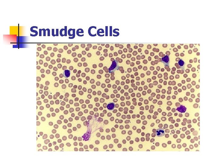 Smudge Cells 