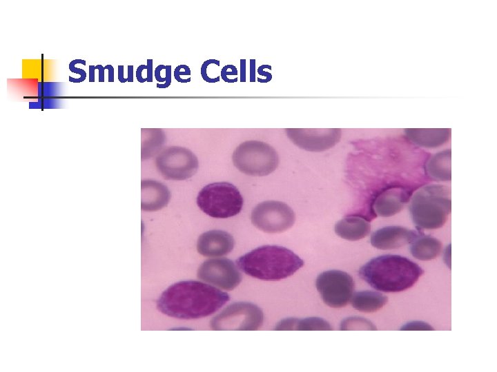 Smudge Cells 