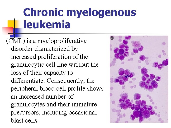 Chronic myelogenous leukemia (CML) is a myeloproliferative disorder characterized by increased proliferation of the