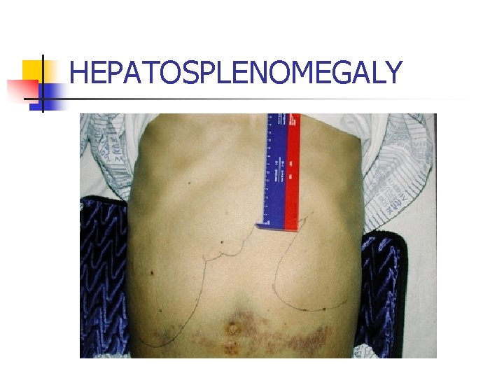 HEPATOSPLENOMEGALY 