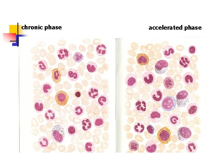 chronic phase accelerated phase 