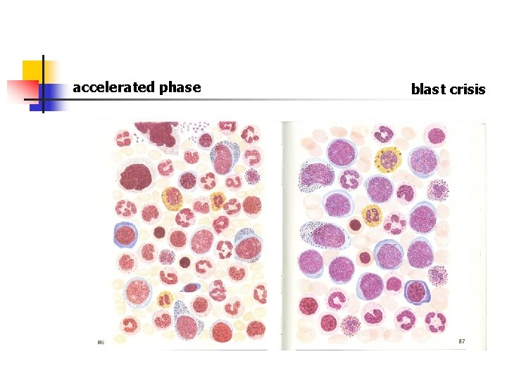 accelerated phase blast crisis 