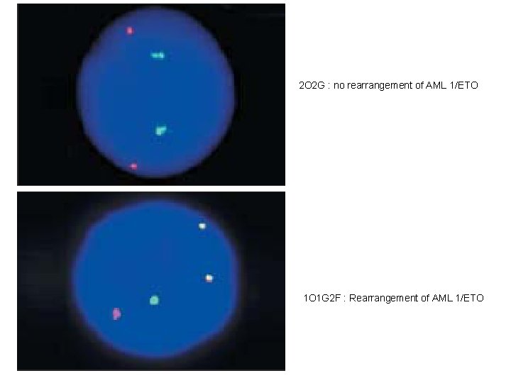 2 O 2 G : no rearrangement of AML 1/ETO 1 O 1 G 2 O 2 G : no rearrangement of AML 1/ETO 1 O 1 G