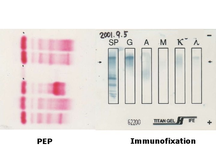 Photo - PEP & densitometry PEP Immunofixation Photo - PEP & densitometry PEP Immunofixation