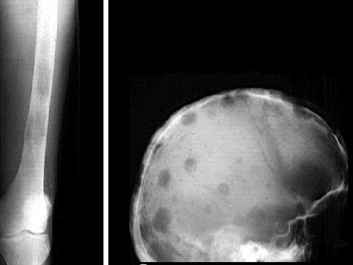 Photo -osteolytic lesion Photo -osteolytic lesion