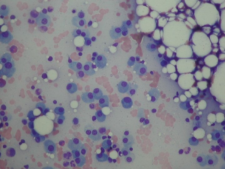 Photo - BM plasma cell Photo - BM plasma cell