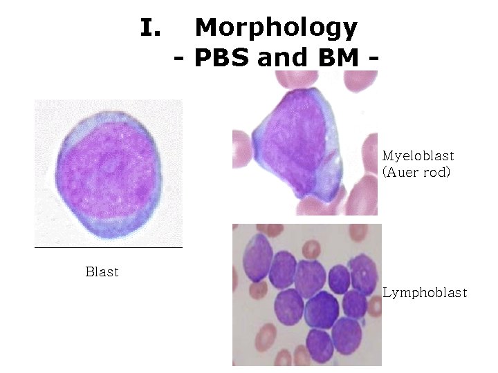 I. Morphology - PBS and BM - Myeloblast (Auer rod) Blast Lymphoblast I. Morphology - PBS and BM - Myeloblast (Auer rod) Blast Lymphoblast