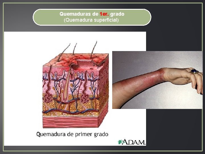 Quemaduras de 1 er. grado (Quemadura superficial) Quemaduras de 1 er. grado (Quemadura superficial)