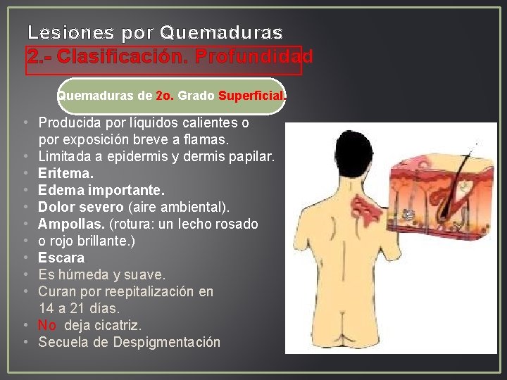 Lesiones por Quemaduras 2. - Clasificación. Profundidad Quemaduras de 2 o. Grado Superficial. • Lesiones por Quemaduras 2. - Clasificación. Profundidad Quemaduras de 2 o. Grado Superficial. •