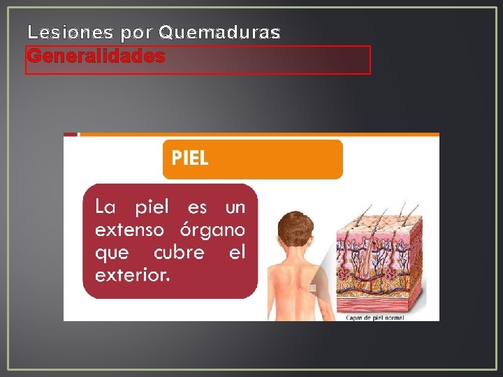 Lesiones por Quemaduras Generalidades Lesiones por Quemaduras Generalidades