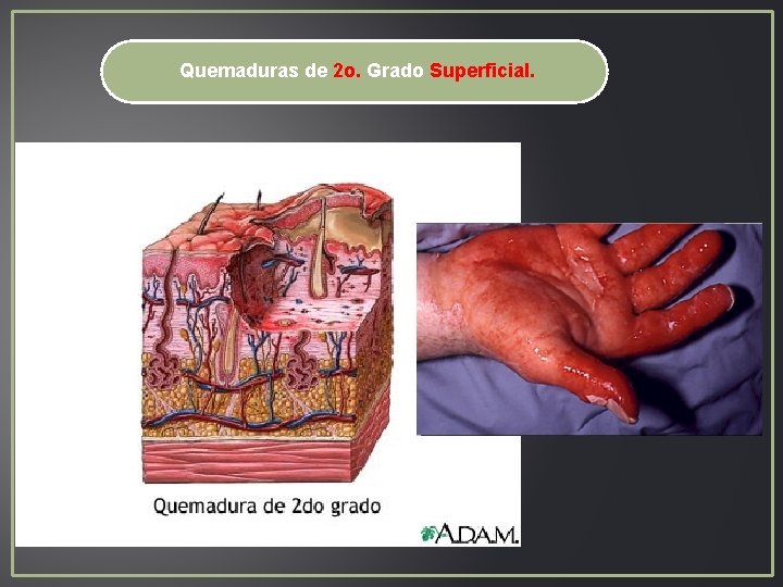 Quemaduras de 2 o. Grado Superficial. Quemaduras de 2 o. Grado Superficial.