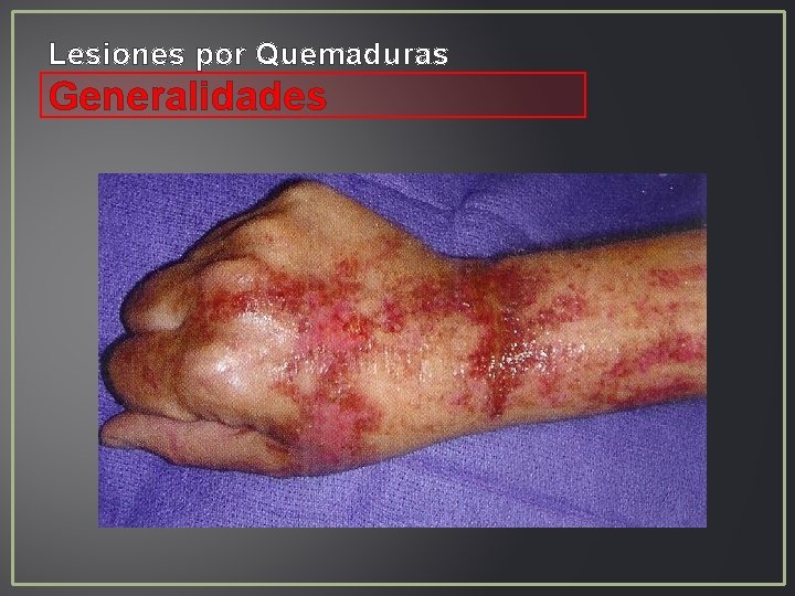 Lesiones por Quemaduras Generalidades Lesiones por Quemaduras Generalidades