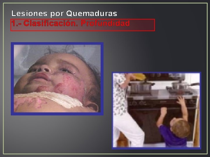 Lesiones por Quemaduras 1. - Clasificación. Profundidad Lesiones por Quemaduras 1. - Clasificación. Profundidad