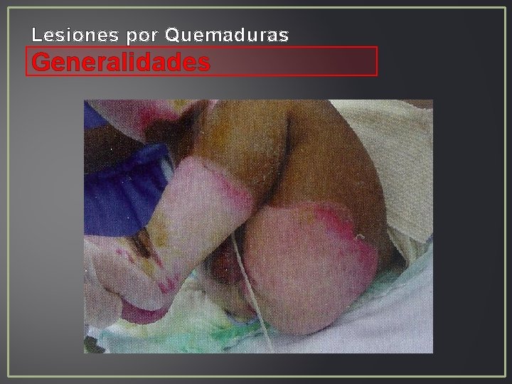 Lesiones por Quemaduras Generalidades Lesiones por Quemaduras Generalidades