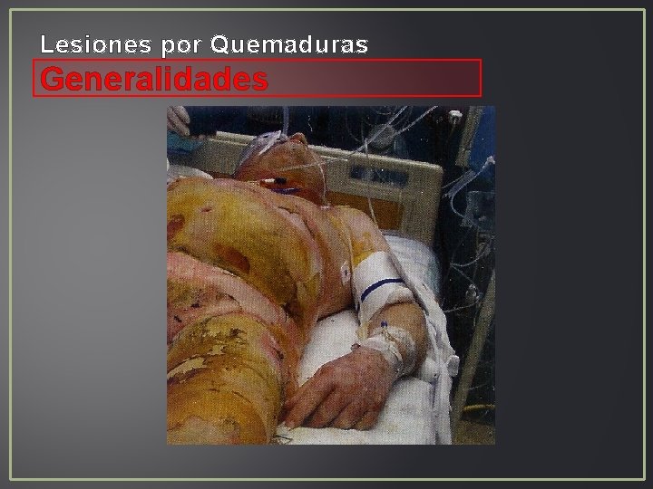 Lesiones por Quemaduras Generalidades Lesiones por Quemaduras Generalidades