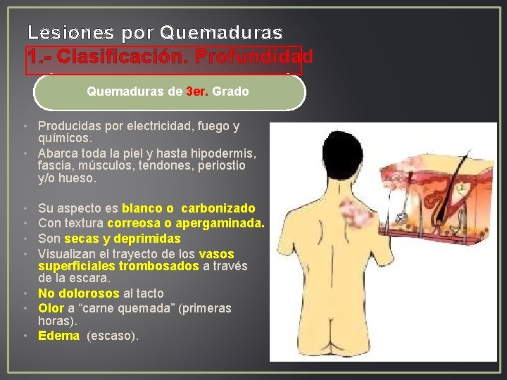 Lesiones por Quemaduras 1. - Clasificación. Profundidad Quemaduras de 3 er. Grado • Producidas Lesiones por Quemaduras 1. - Clasificación. Profundidad Quemaduras de 3 er. Grado • Producidas