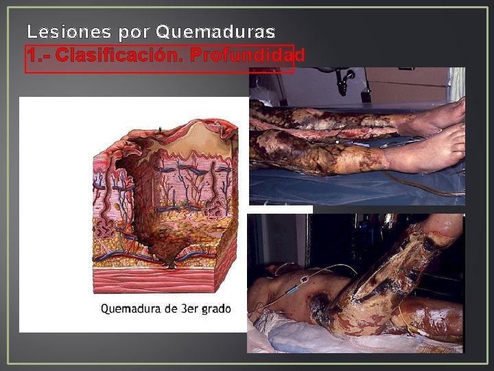 Lesiones por Quemaduras 1. - Clasificación. Profundidad Lesiones por Quemaduras 1. - Clasificación. Profundidad