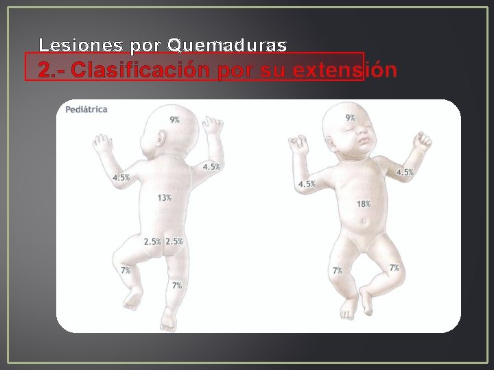 Lesiones por Quemaduras 2. - Clasificación por su extensión Lesiones por Quemaduras 2. - Clasificación por su extensión