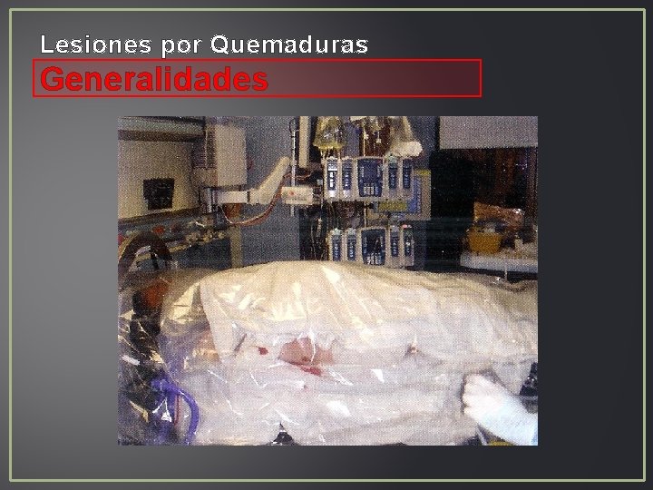 Lesiones por Quemaduras Generalidades Lesiones por Quemaduras Generalidades