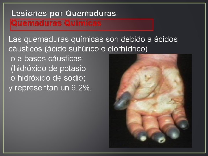 Lesiones por Quemaduras Químicas Las quemaduras químicas son debido a ácidos cáusticos (ácido sulfúrico Lesiones por Quemaduras Químicas Las quemaduras químicas son debido a ácidos cáusticos (ácido sulfúrico