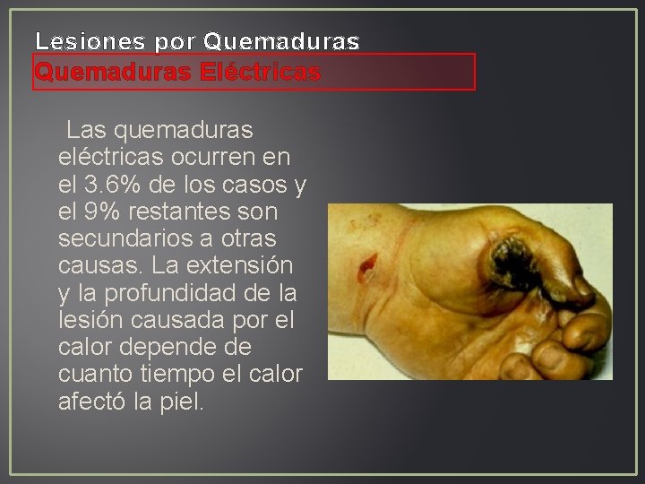 Lesiones por Quemaduras Eléctricas Las quemaduras eléctricas ocurren en el 3. 6% de los Lesiones por Quemaduras Eléctricas Las quemaduras eléctricas ocurren en el 3. 6% de los