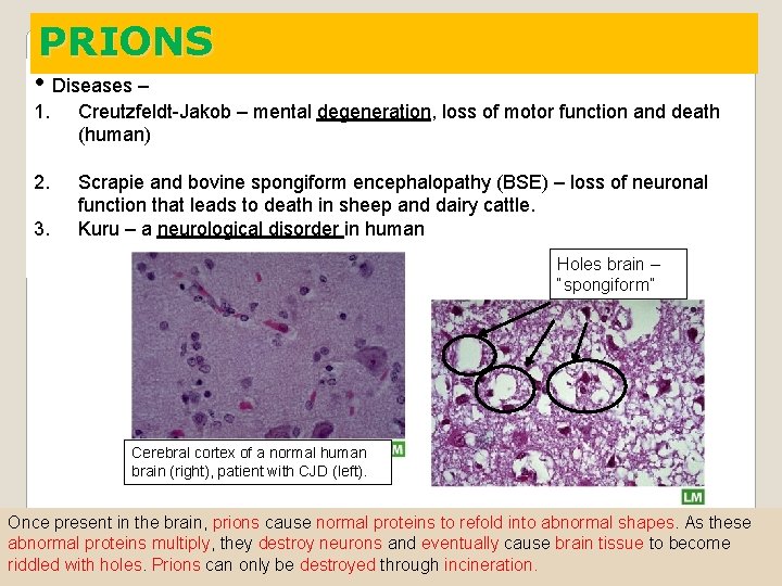 PRIONS • Diseases – 1. Creutzfeldt-Jakob – mental degeneration, loss of motor function and