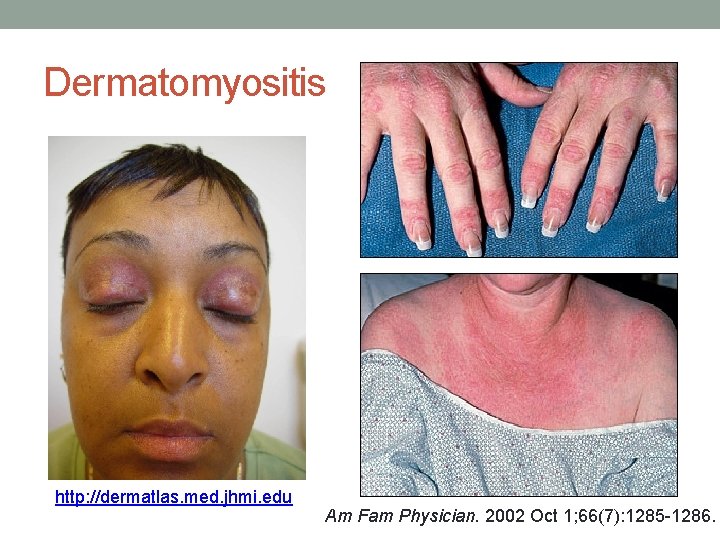 Dermatomyositis http: //dermatlas. med. jhmi. edu Am Fam Physician. 2002 Oct 1; 66(7): 1285