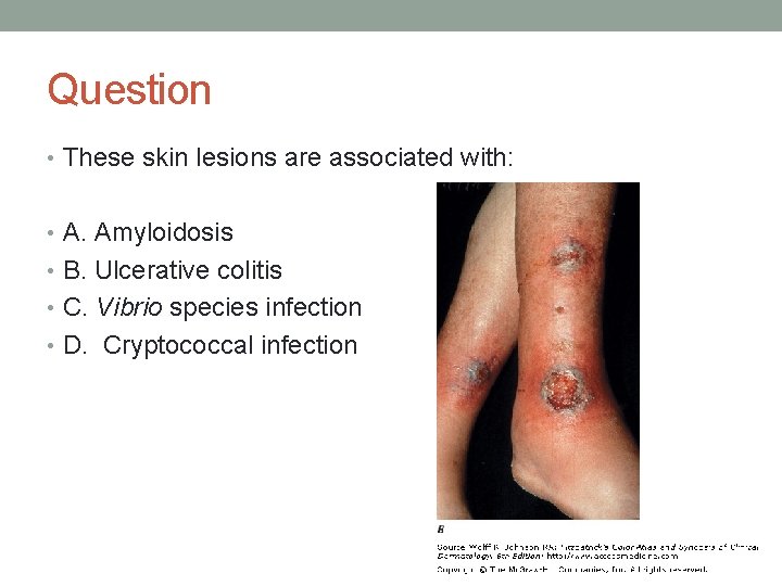 Question • These skin lesions are associated with: • A. Amyloidosis • B. Ulcerative