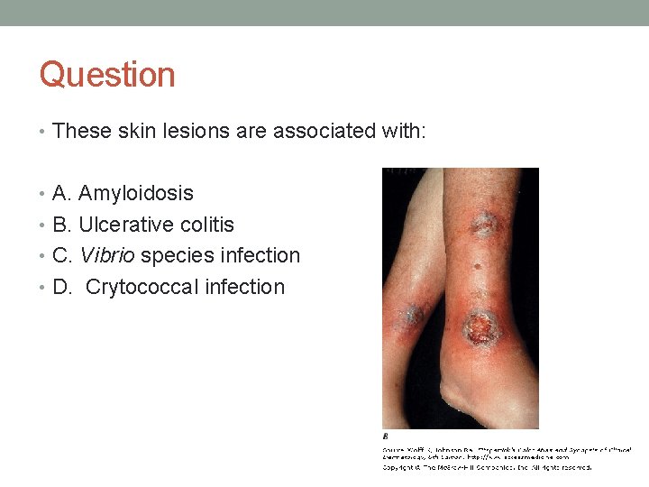 Question • These skin lesions are associated with: • A. Amyloidosis • B. Ulcerative