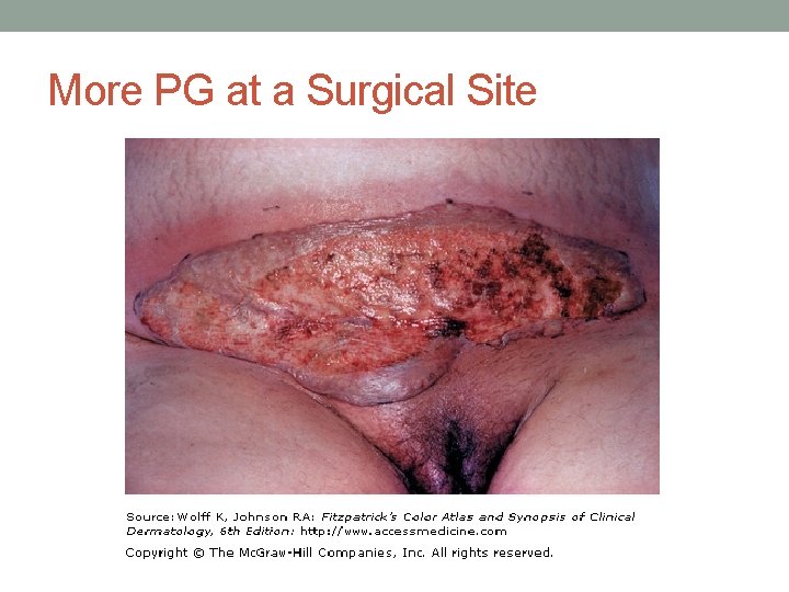 More PG at a Surgical Site 