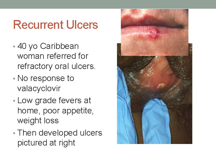 Recurrent Ulcers • 40 yo Caribbean woman referred for refractory oral ulcers. • No