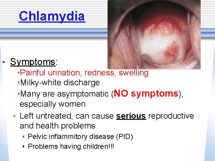 Chlamydia • Symptoms: • Painful urination, redness, swelling • Milky-white discharge • Many are